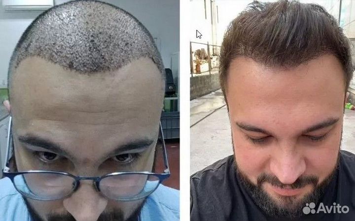 Пересадка волос передовыми методами