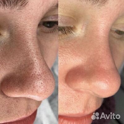 Лечение угревой сыпи