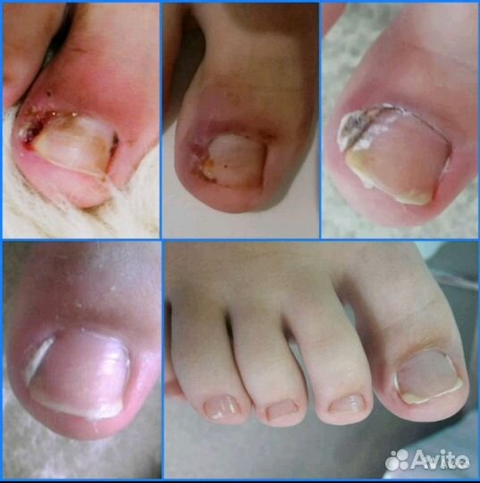 Медицинский педикюр