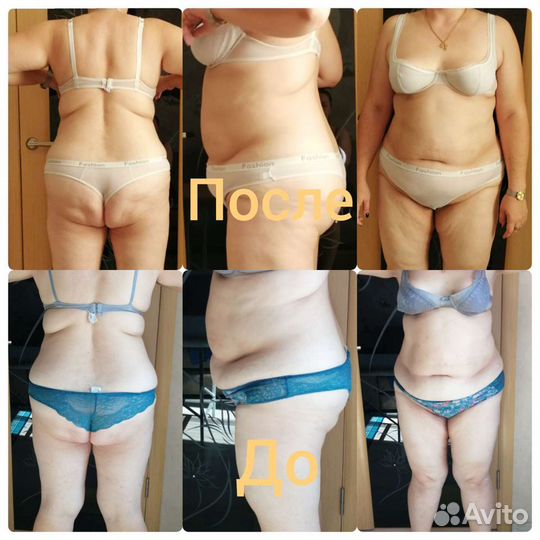 Карамельная липосакция