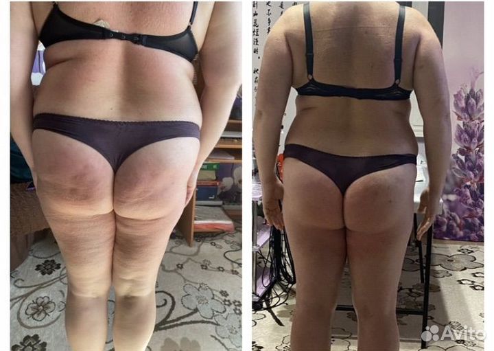 Аппартный массаж для похудения