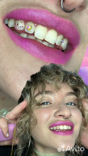 Скайсы Установка кристаллов на зубы