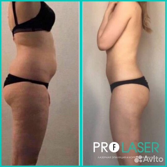 Антицеллюлитный массаж Ручной массаж