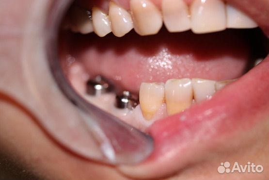 Установка зубных имплантов
