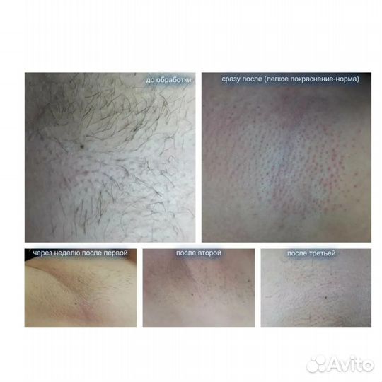 Обучение электроэпиляции