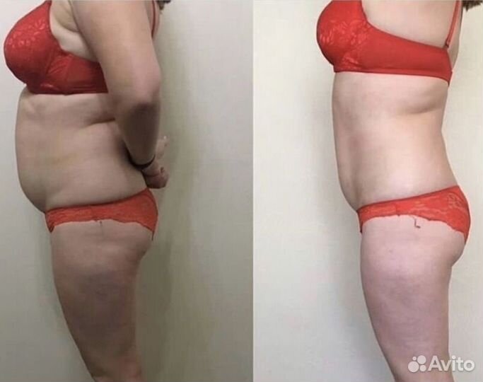 Массаж LPG - целлюлиту бой