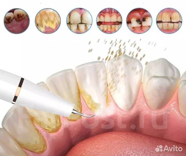 Ультразвуковой скалер,иppигатор,очиститель удалени