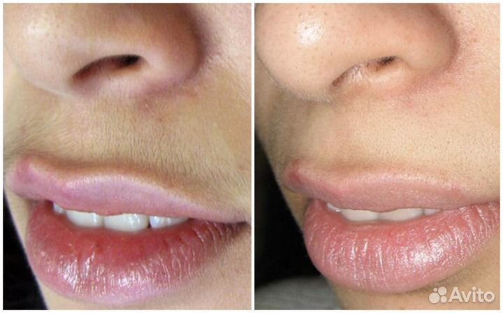 Лазерная Эпиляция