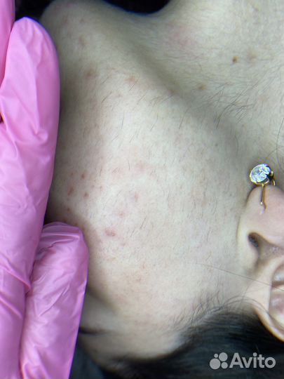 Электроэпиляция: голени