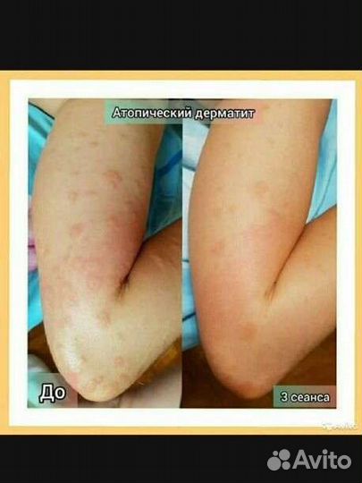 Массаж на биоэнергомассажере Fohow. Марма массаж