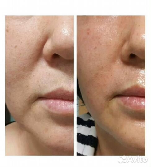 Микроигольчатый РФ лифтинг