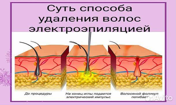 Электроэпиляция