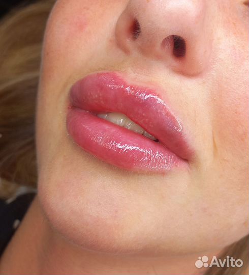 Контурная пластика