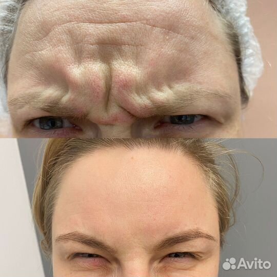 Модель на увеличения губ