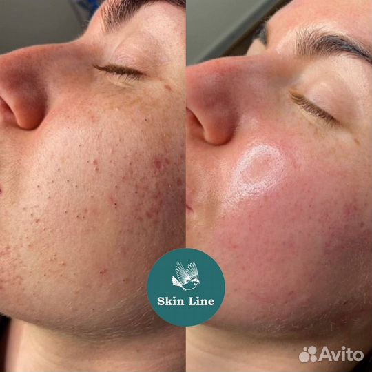 Модели / карбоновый пилинг