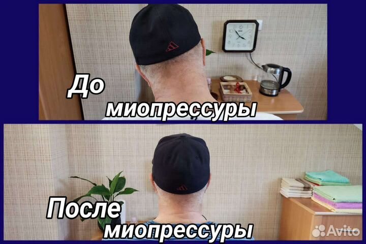 Глубокомышечный массаж Миопрессура