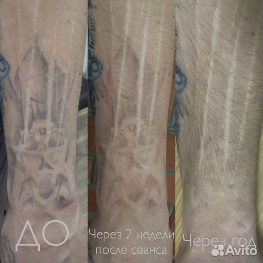 Лазерное удаление тату и татуажа