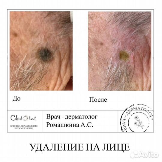 Удаление папиллом, родинок, бородавок