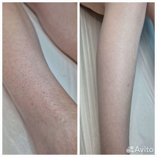 LPG,Коррекция фигуры, Кавитация, Депиляция жд окр