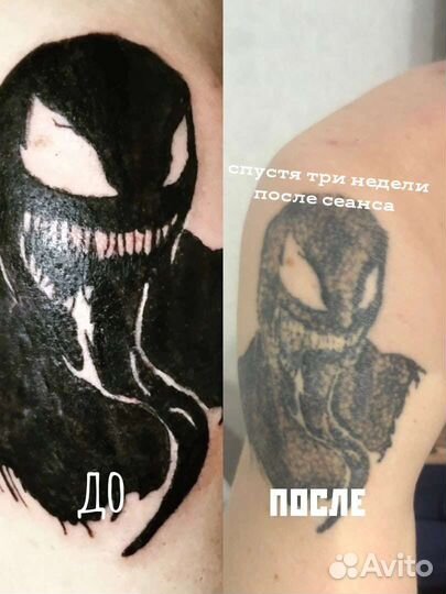 Лазерное удаление татуировок