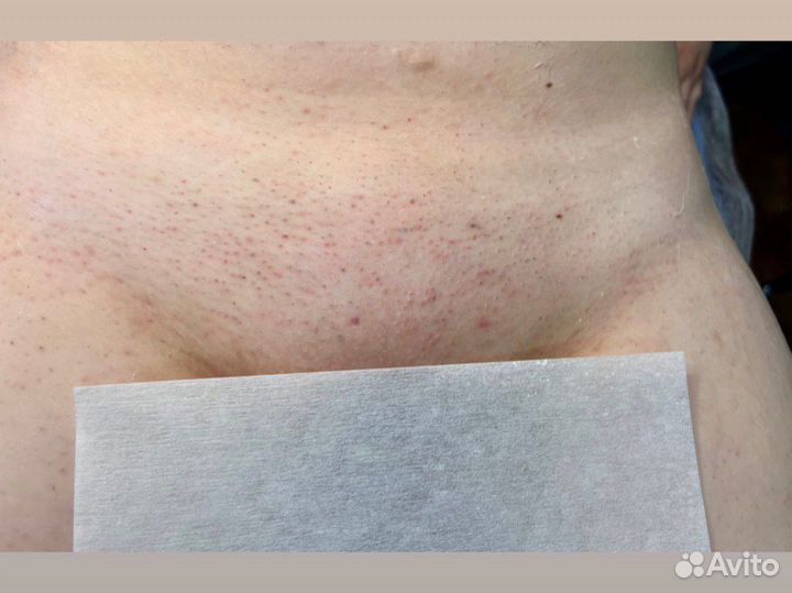 Мастер восковой депиляции