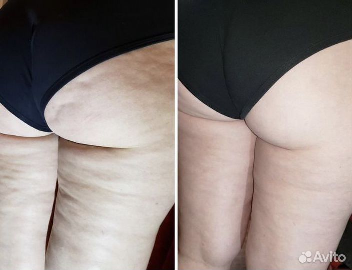 Аппаратный массаж