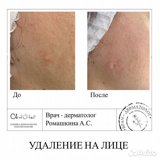 Удаление папиллом, родинок, бородавок