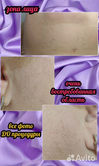 Электроэпиляция