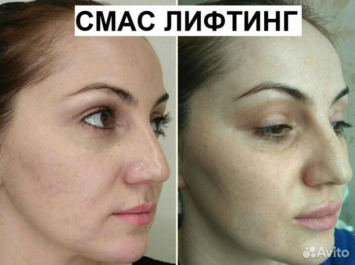 Минус 7 лет на лице