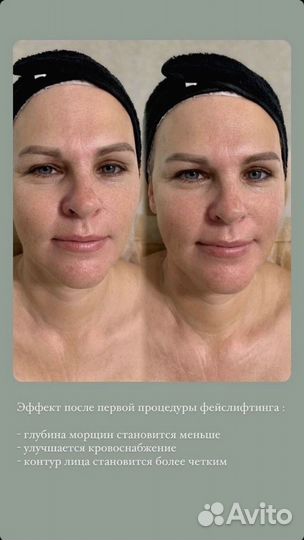 Массаж лица