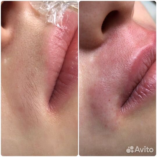 Электроэпиляция (женская/мужская). Игла включена