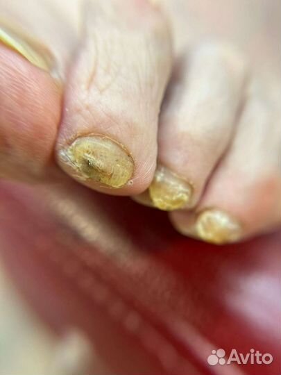Подолог, есть выезд лечебный Педикюр грибок