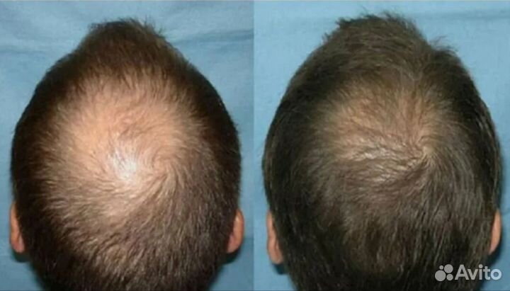 Восстановление роста и густоты волос