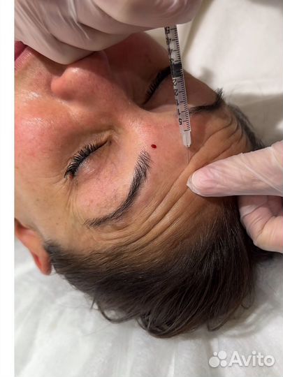 Косметолог увеличение губ ботокс био