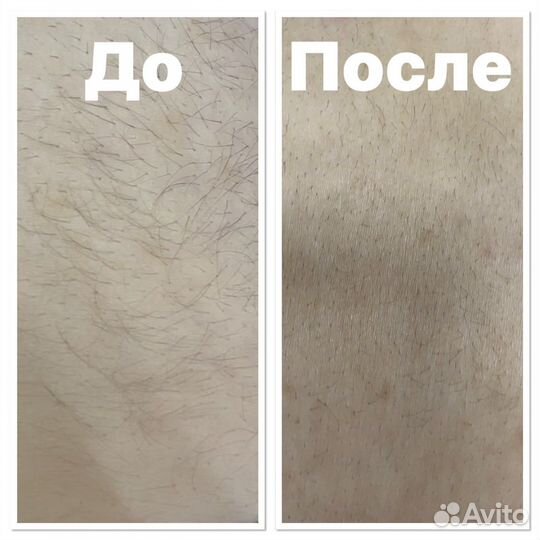 Лазерная эпиляция Элос