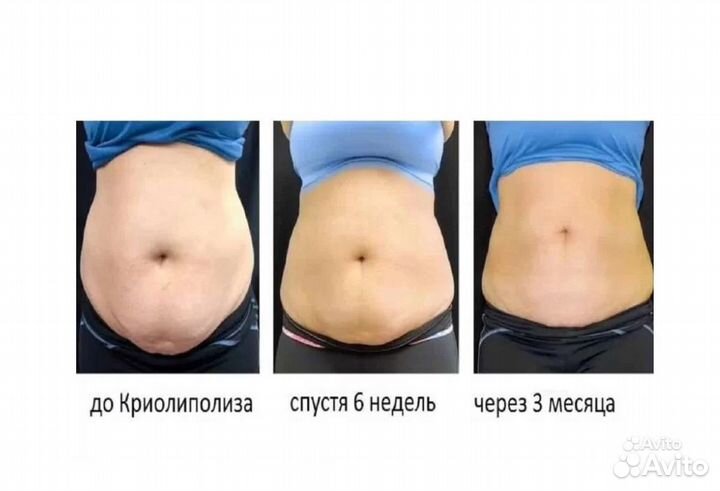 Липосакция без операции в Челябинске