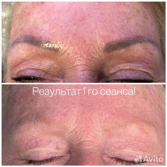 Удаление татуажа и тату