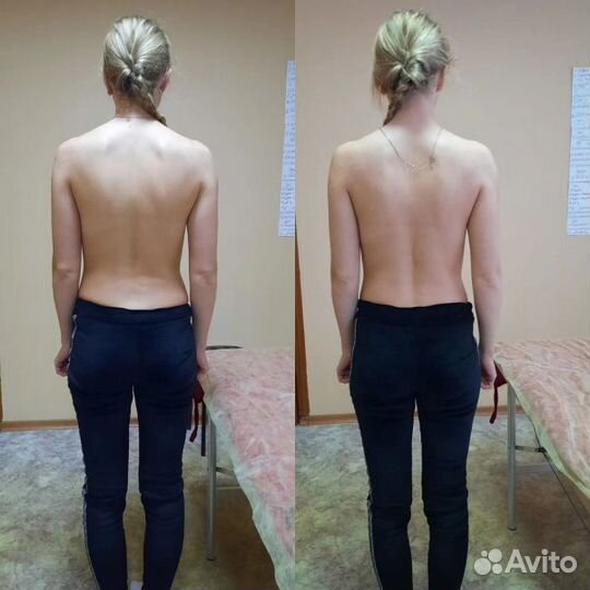 Выпрямление позвоночника