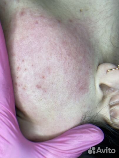 Электроэпиляция: голени