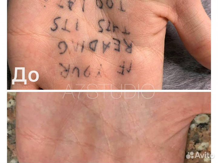 Удаление татуировок