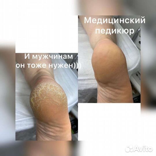Медицинский педикюр. Подолог