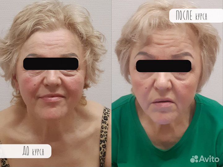 Массаж LPG оригинал Франция, массаж лица