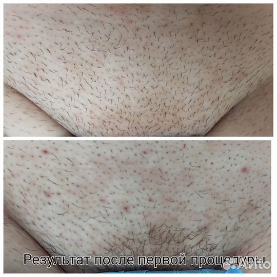 Электроэпиляция