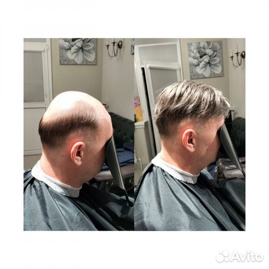 Установка мужской системы замещения волос