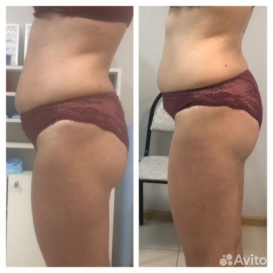 Антицеллюлитный массаж