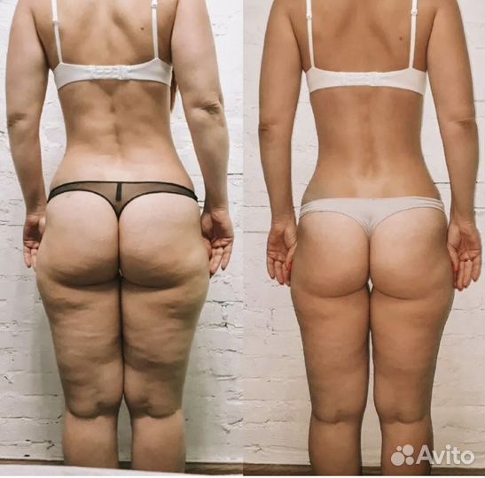 LPG.+Массаж.+Инфракрасный разогрев+Кавитация