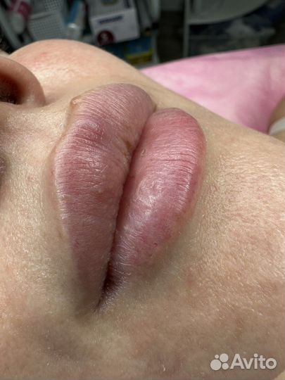 Увеличение губ