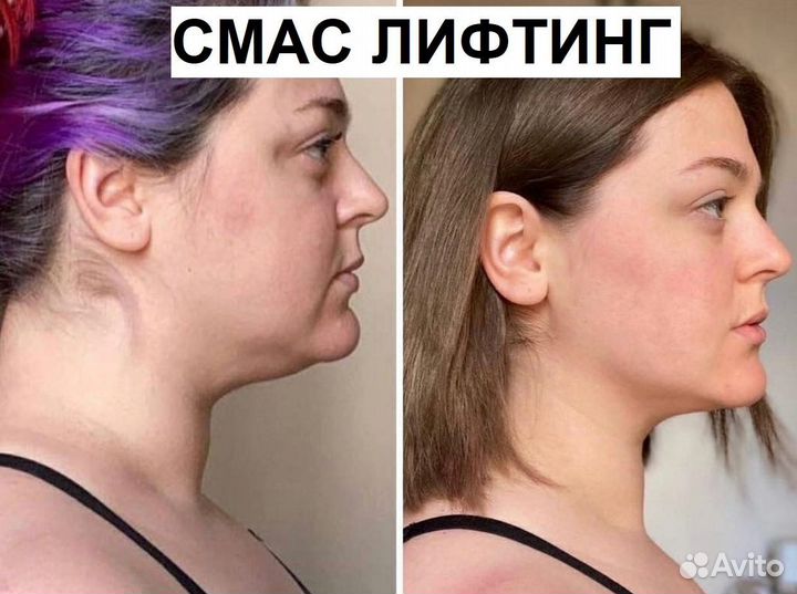 Минус 7 лет на лице