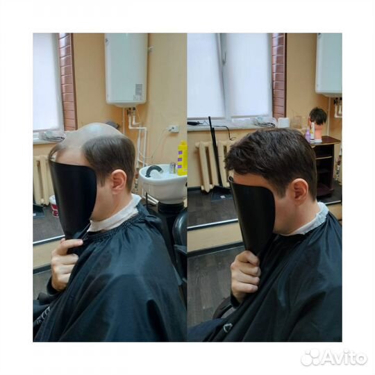 Установка мужской системы замещения волос