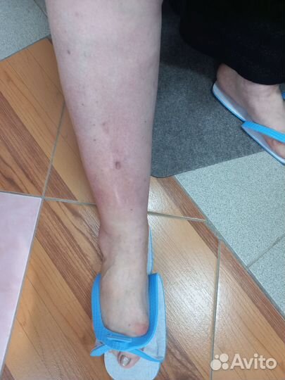 Карбокситерапия